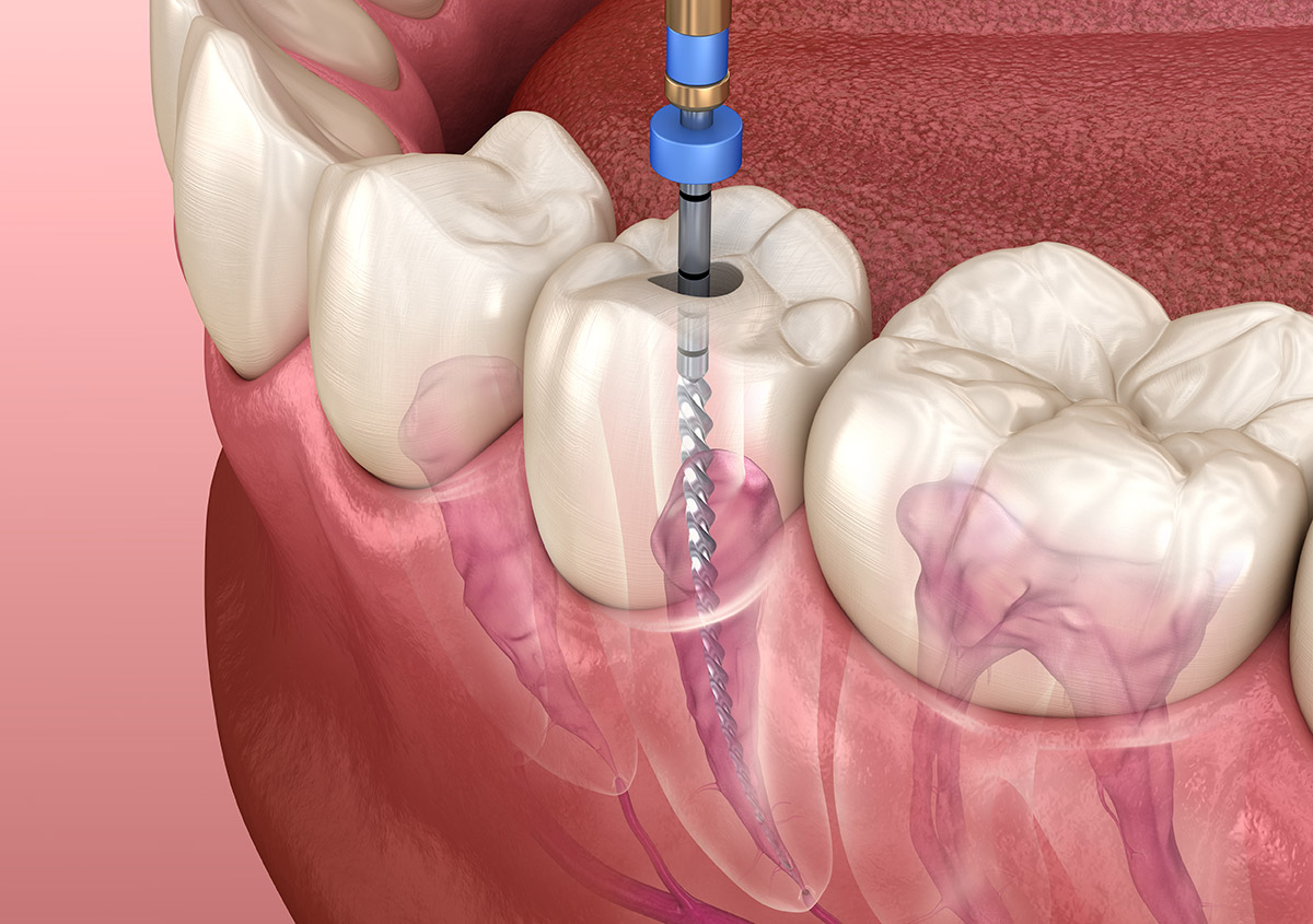 Root Canal Flint MI