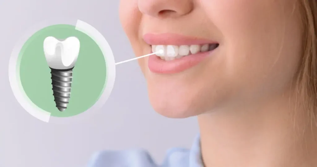 Dental implants in Flint long-lasting tooth replacement solution