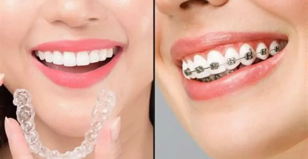 clear aligners vs braces