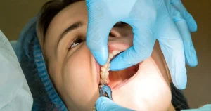 wisdom teeth extraction