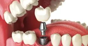 How Much Do Dental Implants Cost Without Insurance