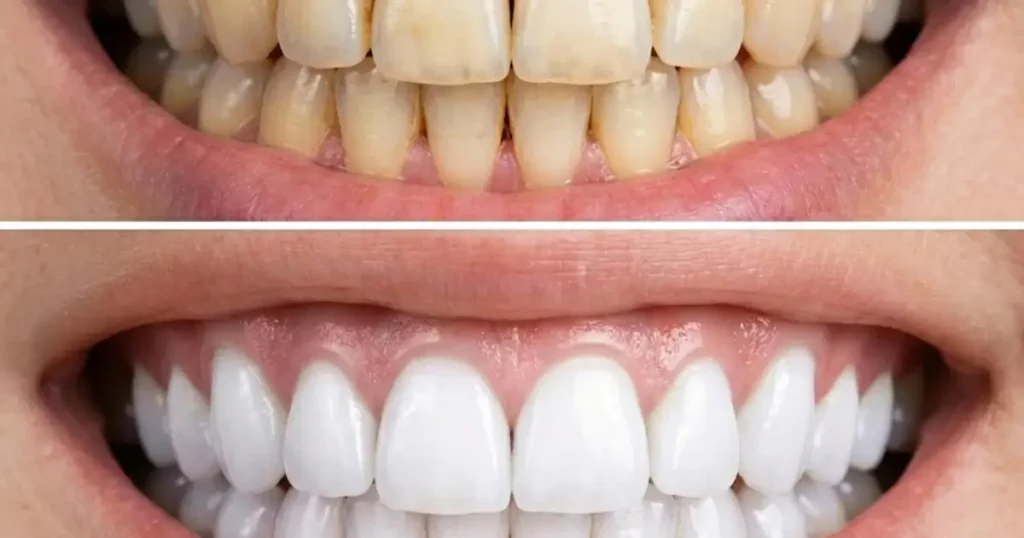 teeth whitening is safe for sensitive teeth