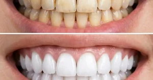 teeth whitening is safe for sensitive teeth
