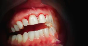bleeding gums when brushing in Flint MI