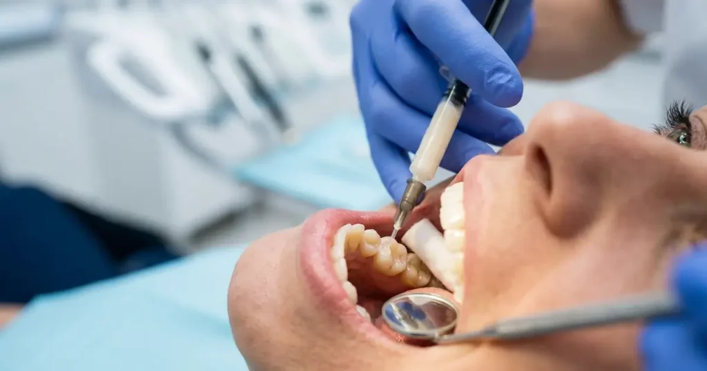 dental sealants for adults
